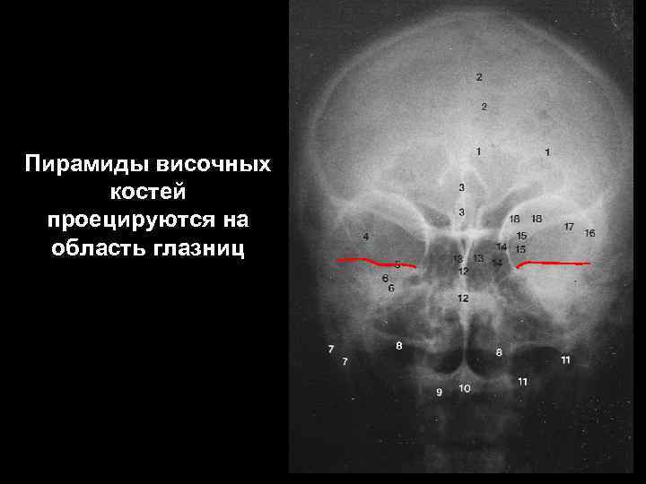 Пирамиды височных костей проецируются на область глазниц 