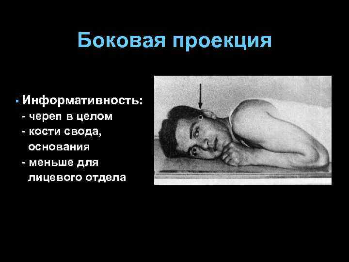 Боковая проекция § Информативность: - череп в целом - кости свода, основания - меньше