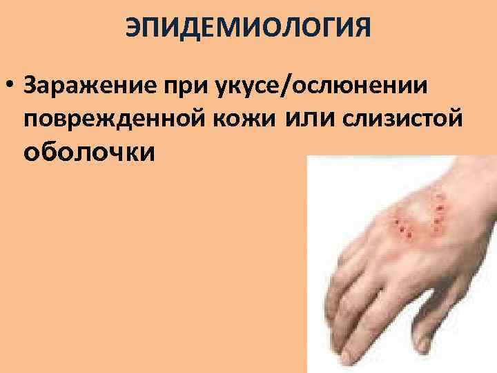 ЭПИДЕМИОЛОГИЯ • Заражение при укусе/ослюнении поврежденной кожи или слизистой оболочки 
