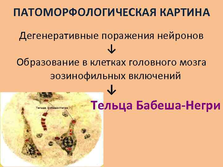 ПАТОМОРФОЛОГИЧЕСКАЯ КАРТИНА Дегенеративные поражения нейронов ↓ Образование в клетках головного мозга эозинофильных включений ↓