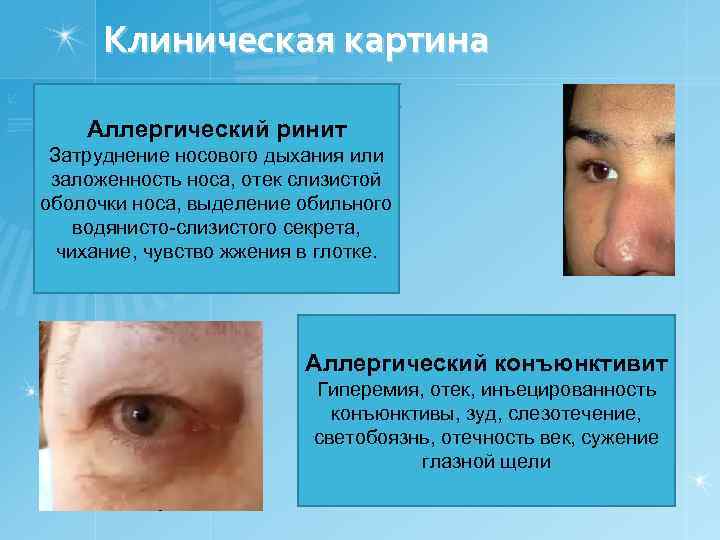 Клиническая картина Аллергический ринит Затруднение носового дыхания или заложенность носа, отек слизистой оболочки носа,