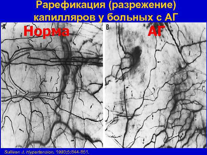 Рарефикация (разрежение) капилляров у больных с АГ Норма Sullivan J. Hypertension. 1993; 5: 844