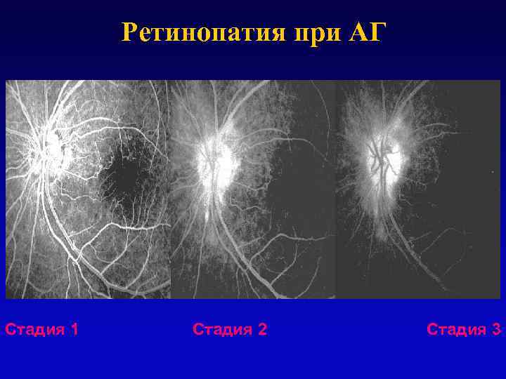 Ретинопатия при АГ Стадия 1 Стадия 2 Стадия 3 