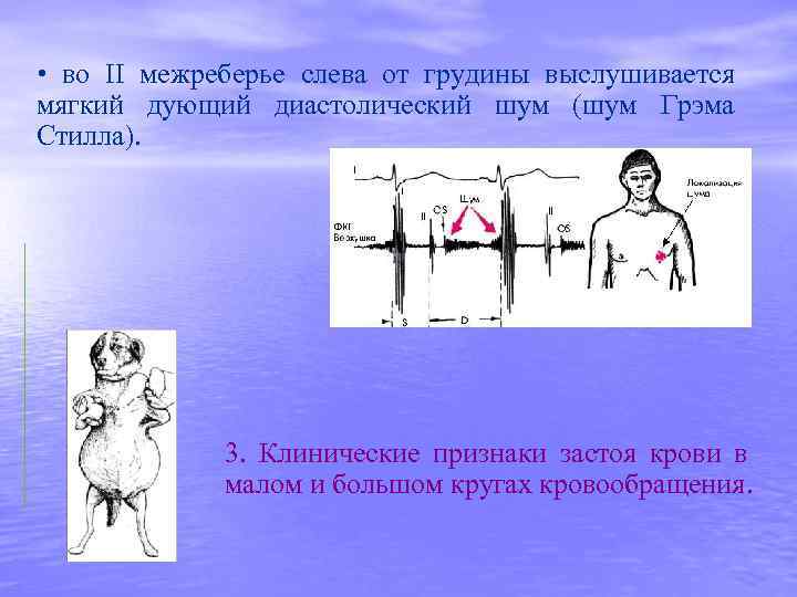  • во II межреберье слева от грудины выслушивается мягкий дующий диастолический шум (шум