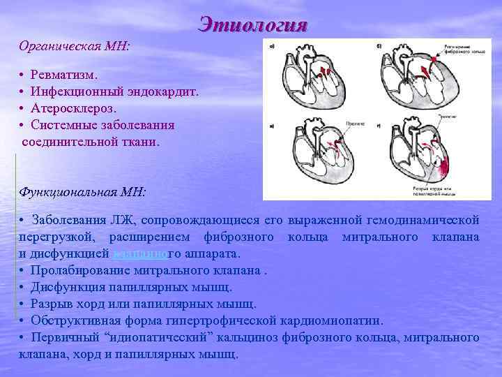 Этиология Органическая МН: • Ревматизм. • Инфекционный эндокардит. • Атеросклероз. • Системные заболевания соединительной