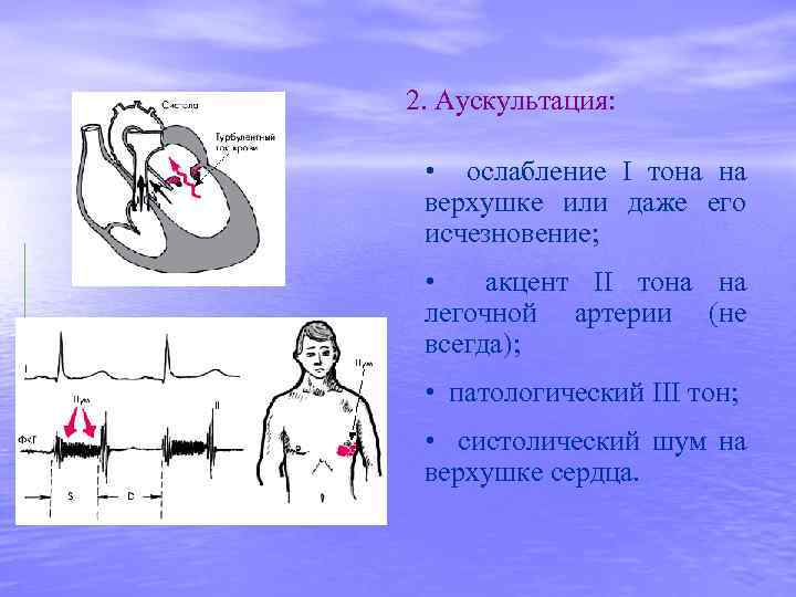 2. Аускультация: • ослабление I тона на верхушке или даже его исчезновение; • акцент