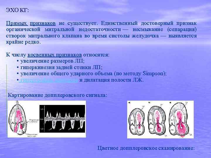 ЭХО КГ: Прямых признаков не существует. Единственный достоверный признак органической митральной недостаточности — несмыкание