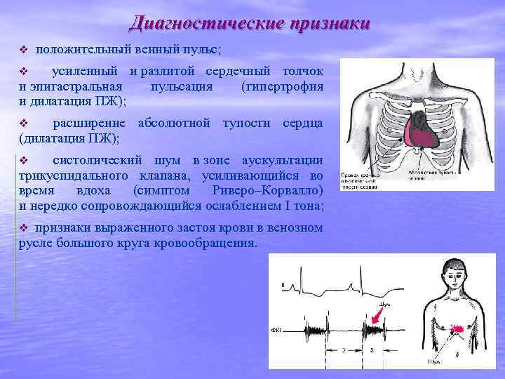 Положительный венный. Положительная венозная пульсация. Сердечная эпигастральная пульсация. Пульсация сердечного толчка. Сердечный толчок усилен.