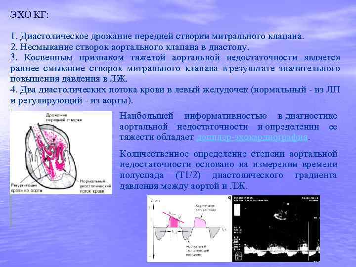 Кооптация створок митрального клапана