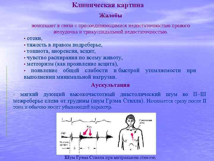 Клиническая картина Жалобы возникают в связи с присоединяющимися недостаточностью правого желудочка и трикуспидальной недостаточностью.