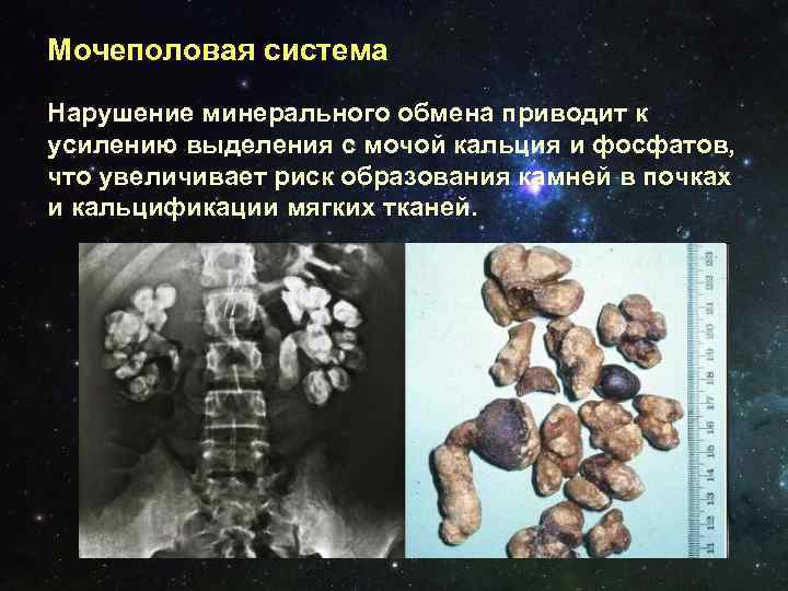 Приводит к образованию. Нарушение минерального обмена. Нарушение минерального обмена патология. Нарушение минерального обмена образование камней. Заболевания связанные с нарушением минерального обмена.