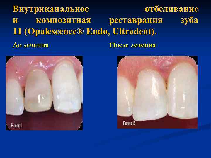 Внутриканальное отбеливание и композитная реставрация зуба 11 (Opalescence® Endo, Ultradent). До лечения После лечения