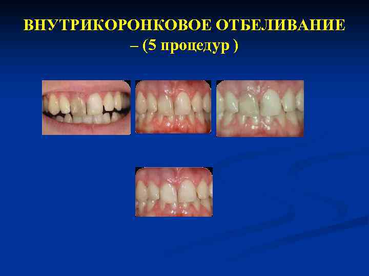 ВНУТРИКОРОНКОВОЕ ОТБЕЛИВАНИЕ – (5 процедур ) 
