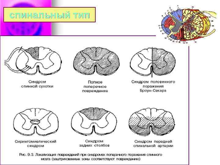 спинальный тип 
