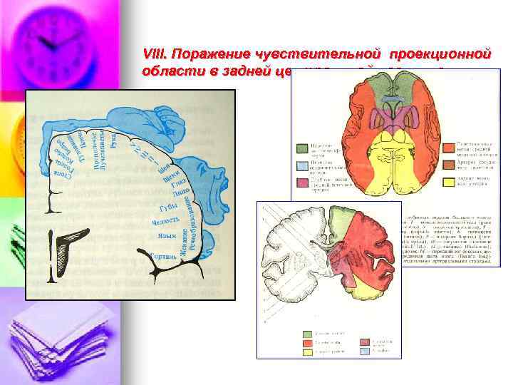 VIII. Поражение чувствительной проекционной области в задней центральной извилине 