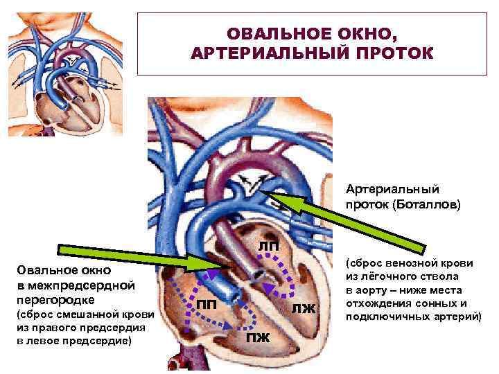 Агенезия венозного протока. Открытый артериальный проток, открытое овальное окно. Овальное окно и боталлов проток. Овальное окно в сердце и боталлов проток. Овальное окно и боталлов проток у плода.