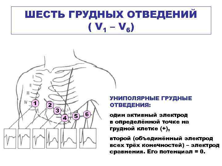 ШЕСТЬ ГРУДНЫХ ОТВЕДЕНИЙ ( V 1 – V 6) 1 2 3 УНИПОЛЯРНЫЕ ГРУДНЫЕ
