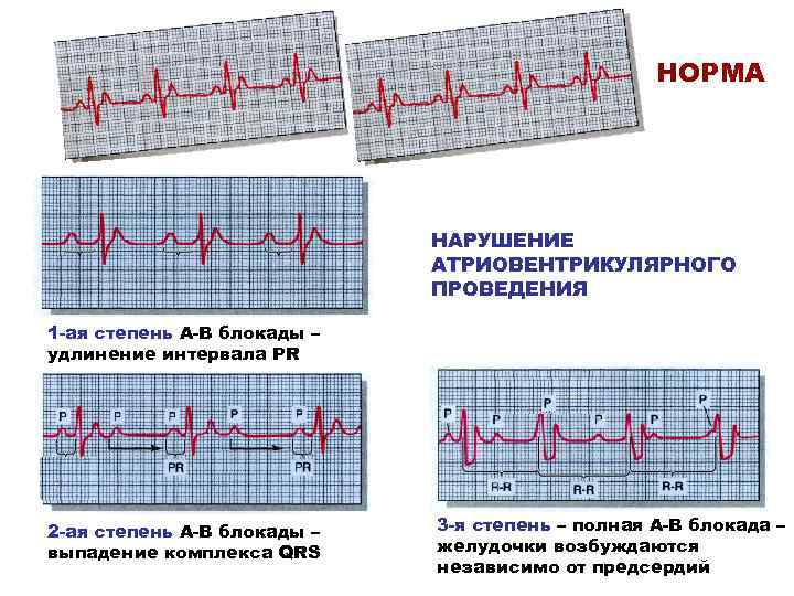 Экг НОРМА НАРУШЕНИЕ АТРИОВЕНТРИКУЛЯРНОГО ПРОВЕДЕНИЯ 1 -ая степень А-В блокады – удлинение интервала PR