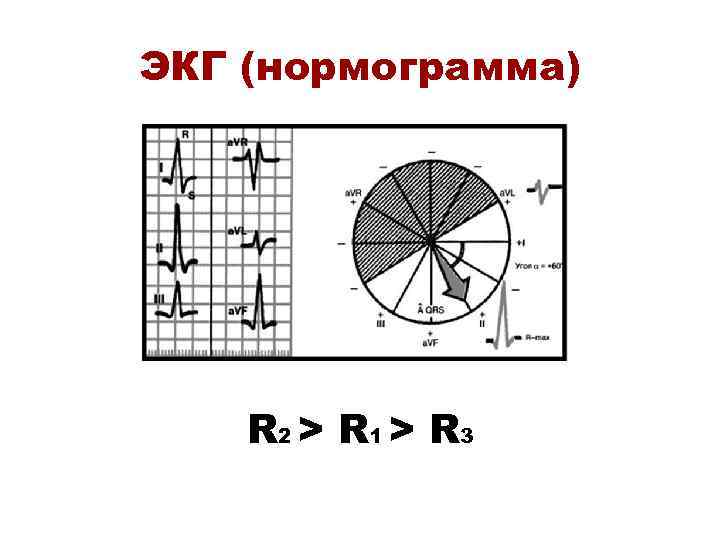 ЭКГ (нормограмма) R 2 > R 1 > R 3 