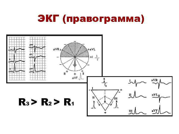 ЭКГ (правограмма) R 3 > R 2 > R 1 