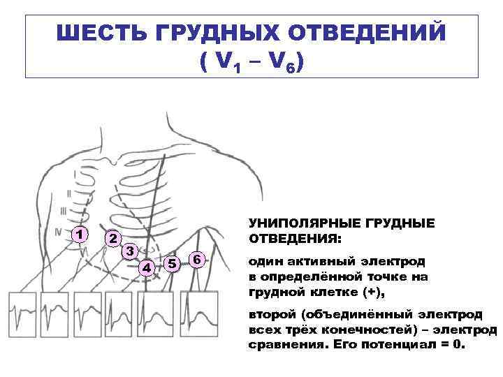 ШЕСТЬ ГРУДНЫХ ОТВЕДЕНИЙ ( V 1 – V 6) 1 2 3 УНИПОЛЯРНЫЕ ГРУДНЫЕ