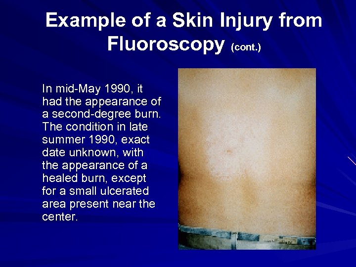 Example of a Skin Injury from Fluoroscopy (cont. ) In mid-May 1990, it had