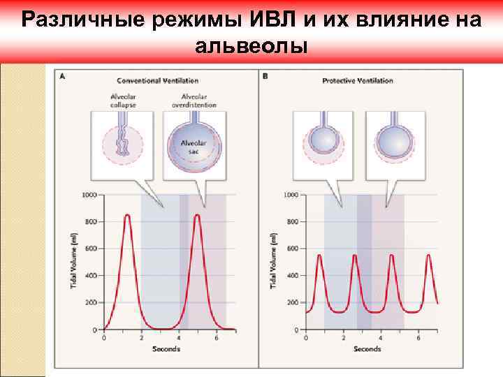 Различные режимы ИВЛ и их влияние на альвеолы 