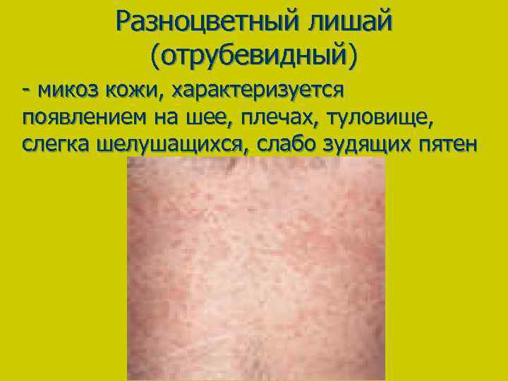 Разноцветный лишай (отрубевидный) - микоз кожи, характеризуется появлением на шее, плечах, туловище, слегка шелушащихся,