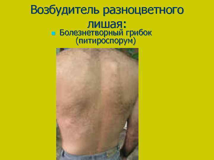 Возбудитель разноцветного лишая: n Болезнетворный грибок (питироспорум) 