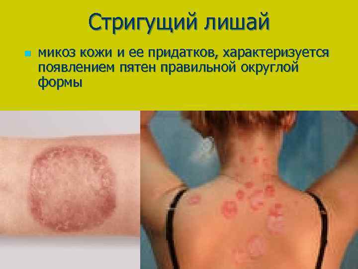 Стригущий лишай n микоз кожи и ее придатков, характеризуется появлением пятен правильной округлой формы