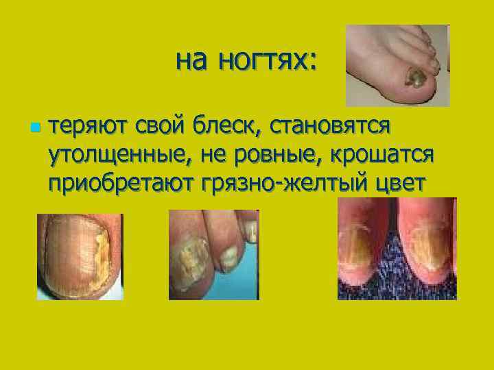 на ногтях: n теряют свой блеск, становятся утолщенные, не ровные, крошатся приобретают грязно-желтый цвет