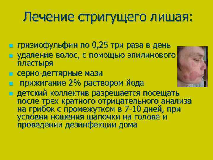 Лечение стригущего лишая: n n n гризиофульфин по 0, 25 три раза в день