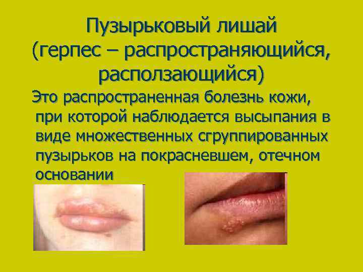 Пузырьковый лишай (герпес – распространяющийся, расползающийся) Это распространенная болезнь кожи, при которой наблюдается высыпания