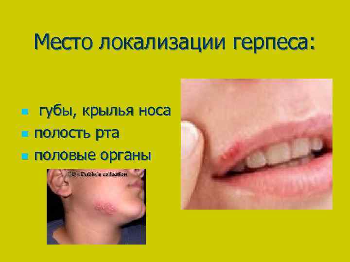 Место локализации герпеса: n n n губы, крылья носа полость рта половые органы 