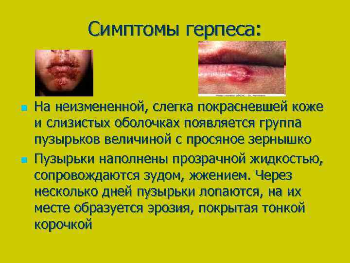 Симптомы герпеса: n n На неизмененной, слегка покрасневшей коже и слизистых оболочках появляется группа
