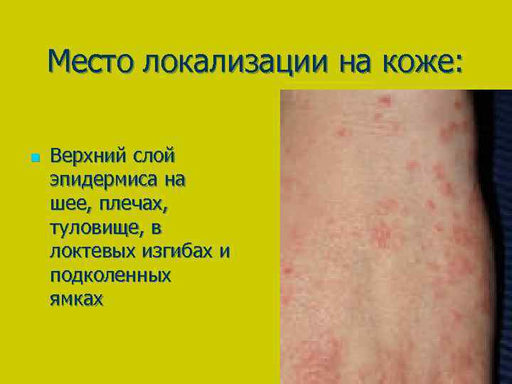 Место локализации на коже: n Верхний слой эпидермиса на шее, плечах, туловище, в локтевых