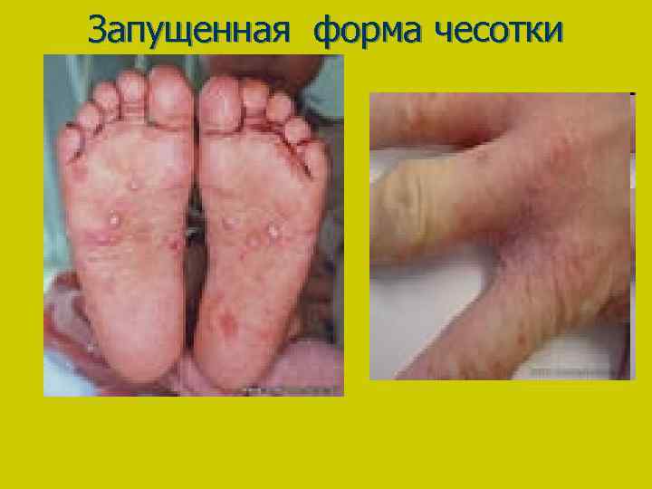 Запущенная форма чесотки 