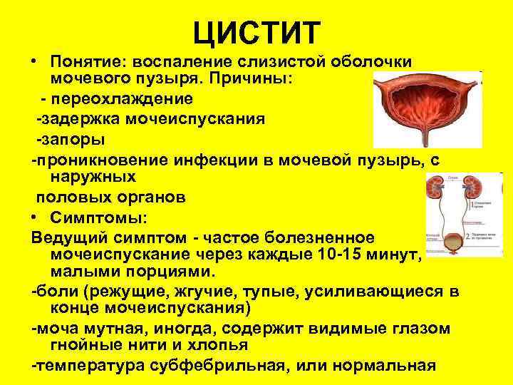 ЦИСТИТ • Понятие: воспаление слизистой оболочки мочевого пузыря. Причины: - переохлаждение -задержка мочеиспускания -запоры