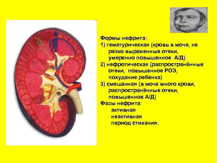 Формы нефрита: 1) гематурическая (кровь в моче, не резко выраженные отеки, умеренно повышенное А/Д)