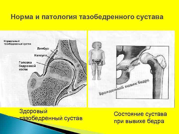 Патология тазобедренного сустава. Грибовидная форма головки бедренной кости. Грибовидная деформация головки бедренной. Головка бедренной кости при врожденном вывихе.