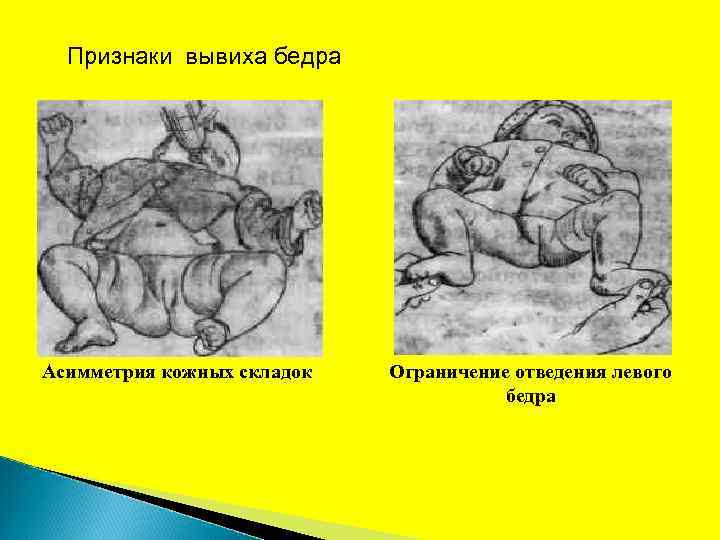 Признаки вывиха бедра Асимметрия кожных складок Ограничение отведения левого бедра 