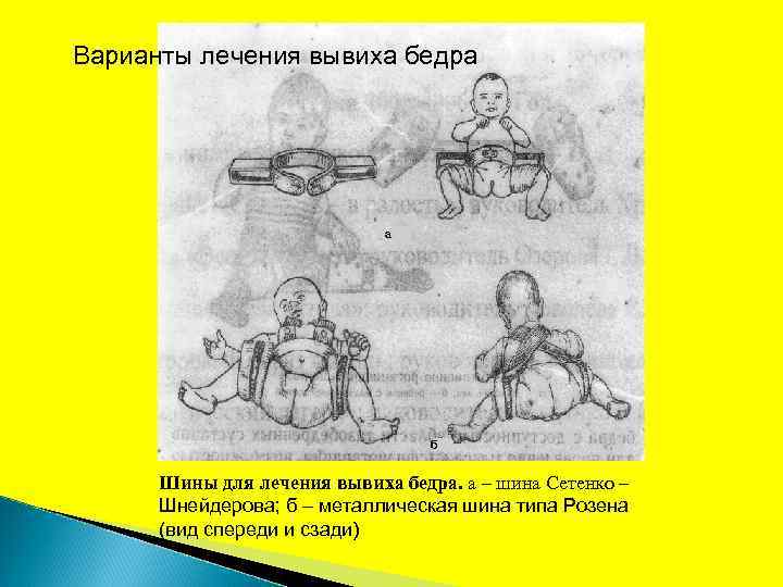 Варианты лечения вывиха бедра Шины для лечения вывиха бедра. a – шина Сетенко –