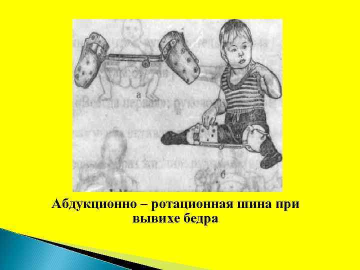 Абдукционно – ротационная шина при вывихе бедра 