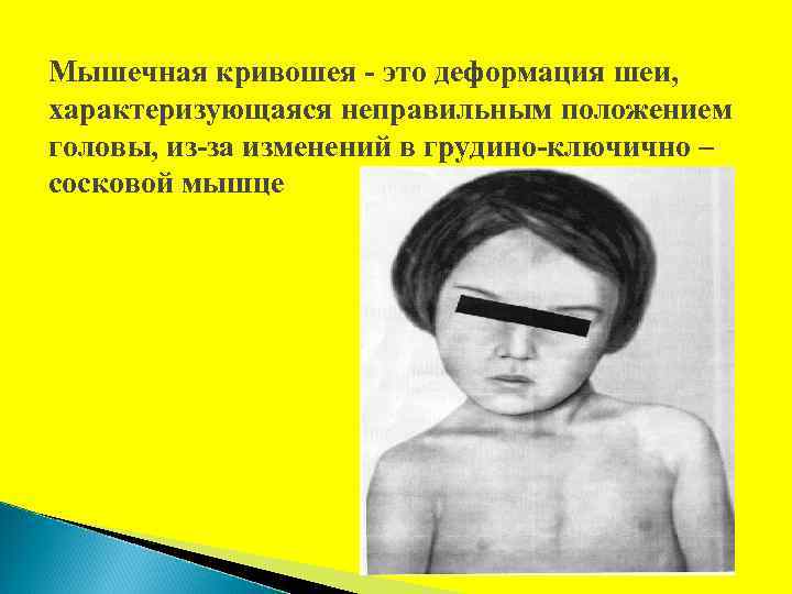 Мышечная кривошея - это деформация шеи, характеризующаяся неправильным положением головы, из-за изменений в грудино-ключично