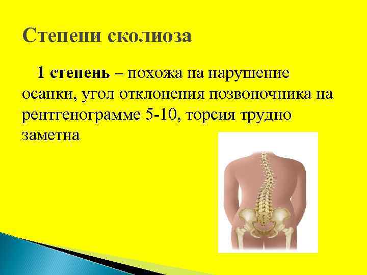 Степени сколиоза 1 степень – похожа на нарушение осанки, угол отклонения позвоночника на рентгенограмме