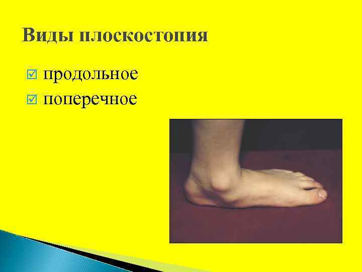 Виды плоскостопия продольное þ поперечное þ 