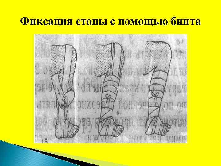 Фиксация стопы с помощью бинта 