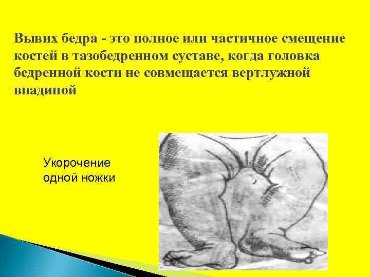 Вывих бедра - это полное или частичное смещение костей в тазобедренном суставе, когда головка