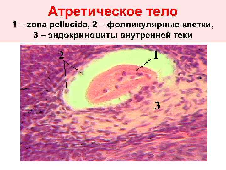 Атретическое тело 1 – zona pellucida, 2 – фолликулярные клетки, 3 – эндокриноциты внутренней