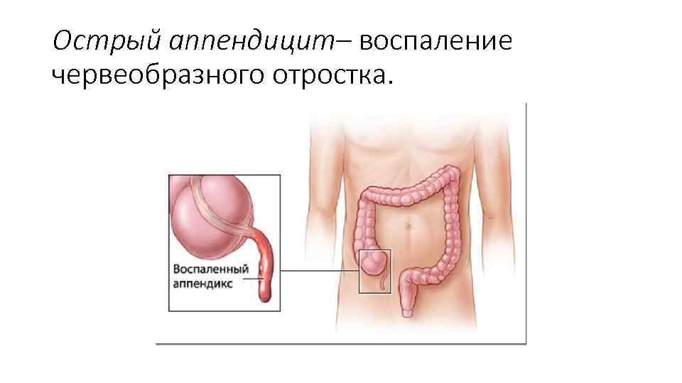 B клинической картине острого аппендицита c развитием деструкции червеобразного отростка